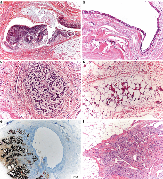 Germ Cell Tumors Of The Female Genital Tract | Basicmedical Key