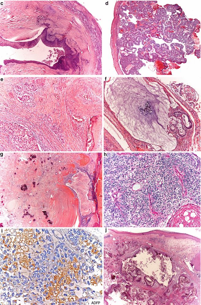 Germ Cell Tumors Of The Female Genital Tract | Basicmedical Key