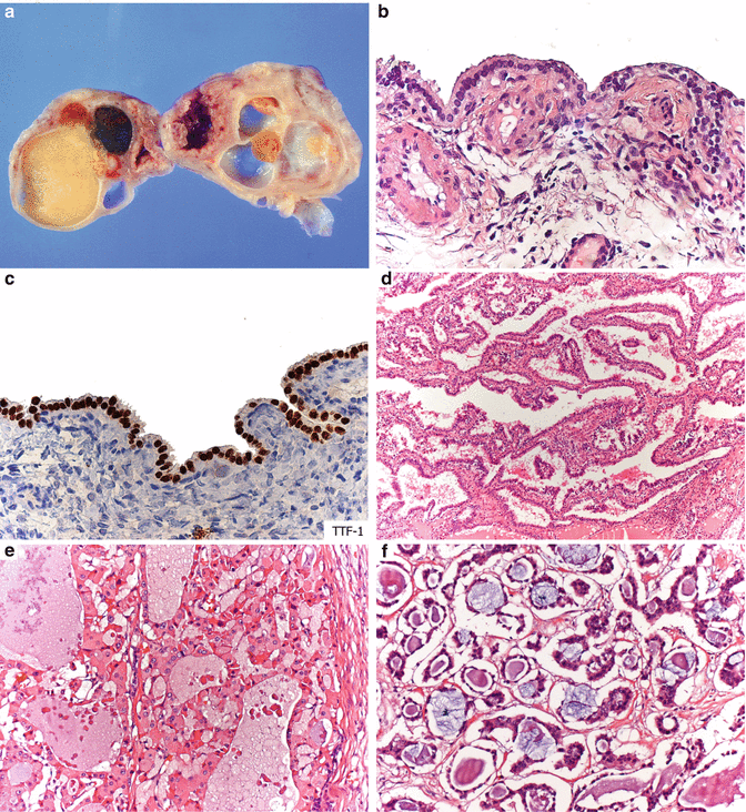 Germ Cell Tumors Of The Female Genital Tract | Basicmedical Key