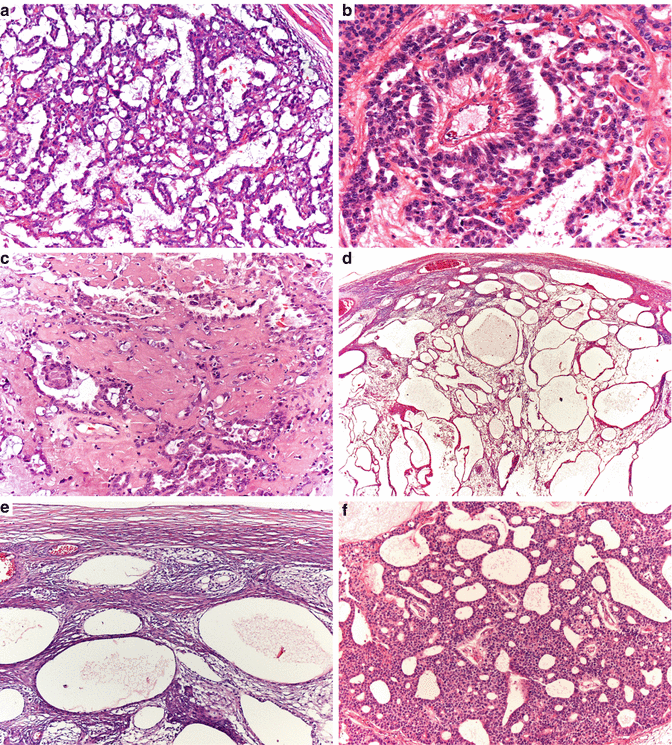 Germ Cell Tumors Of The Female Genital Tract | Basicmedical Key