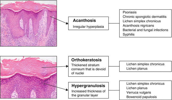 Histological Clues In Interpreting Vulvar Inflammatory And Autoimmune ...