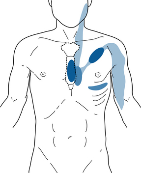 Chest Pain | Basicmedical Key