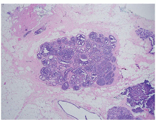 Ductal Carcinoma In Situ | Basicmedical Key