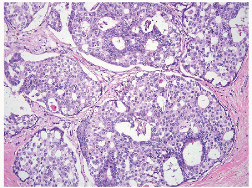 Ductal Carcinoma In Situ | Basicmedical Key