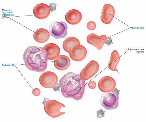 Hematologic Disorders | Basicmedical Key