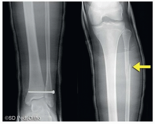 Tibia And Fibula | Basicmedical Key