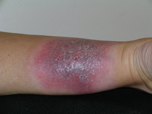 Early Cutaneous T Cell Lymphoma Rash