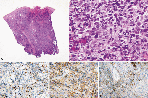 Primary Cutaneous Follicle-Center B-Cell Lymphoma | Basicmedical Key