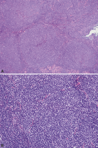 Primary Cutaneous Follicle-Center B-Cell Lymphoma | Basicmedical Key