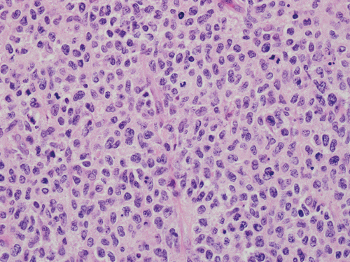 Primary Cutaneous Follicle-Center B-Cell Lymphoma | Basicmedical Key