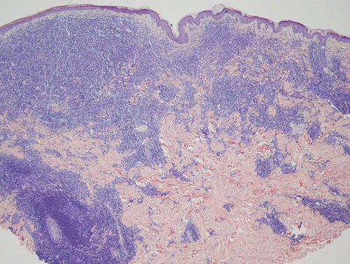 Primary Cutaneous Marginal Zone B-Cell Lymphoma | Basicmedical Key