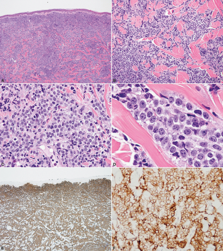 Cutaneous Involvement In Systemic Diffuse Large B-Cell Lymphomas ...