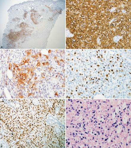 Cutaneous Involvement In Systemic Diffuse Large B-Cell Lymphomas ...