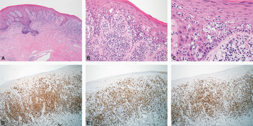 Cutaneous Lymphoid Hyperplasia And Related Entities | Basicmedical Key