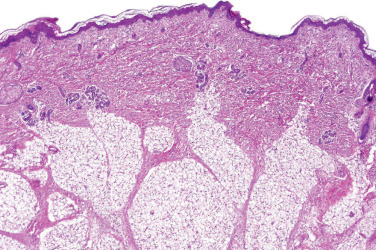 Adipocytic Tumors | Basicmedical Key