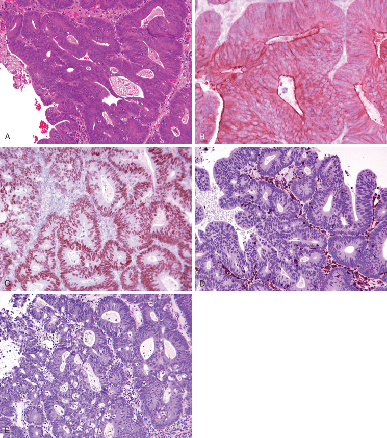 Immunohistology Of Carcinoma Of Unknown Primary Site | Basicmedical Key