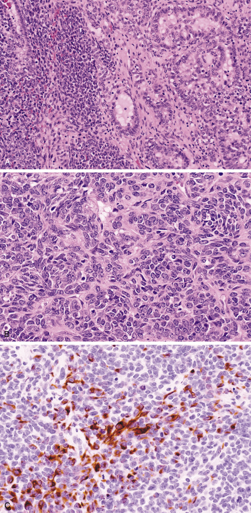 Immunohistochemistry For Analysis Of Soft Tissue Tumors | Basicmedical Key