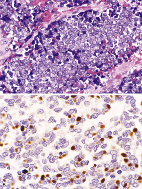 Immunohistochemistry For Analysis Of Soft Tissue Tumors | Basicmedical Key