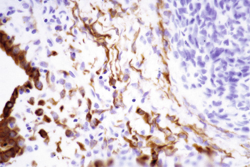 Immunohistochemistry For Analysis Of Soft Tissue Tumors | Basicmedical Key