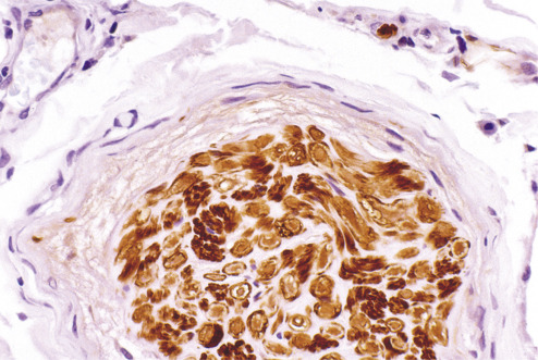 Immunohistochemistry For Analysis Of Soft Tissue Tumors | Basicmedical Key