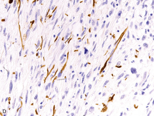 Immunohistochemistry For Analysis Of Soft Tissue Tumors | Basicmedical Key