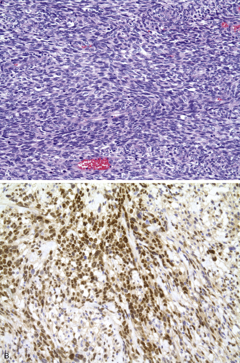 Immunohistochemistry For Analysis Of Soft Tissue Tumors | Basicmedical Key