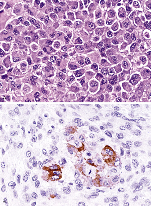 Immunohistochemistry For Analysis Of Soft Tissue Tumors | Basicmedical Key