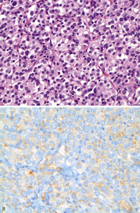 Immunohistochemistry For Analysis Of Soft Tissue Tumors | Basicmedical Key