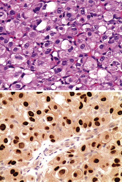 Immunohistochemistry For Analysis Of Soft Tissue Tumors | Basicmedical Key