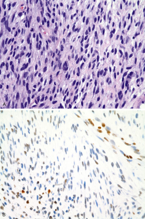 Immunohistochemistry For Analysis Of Soft Tissue Tumors | Basicmedical Key