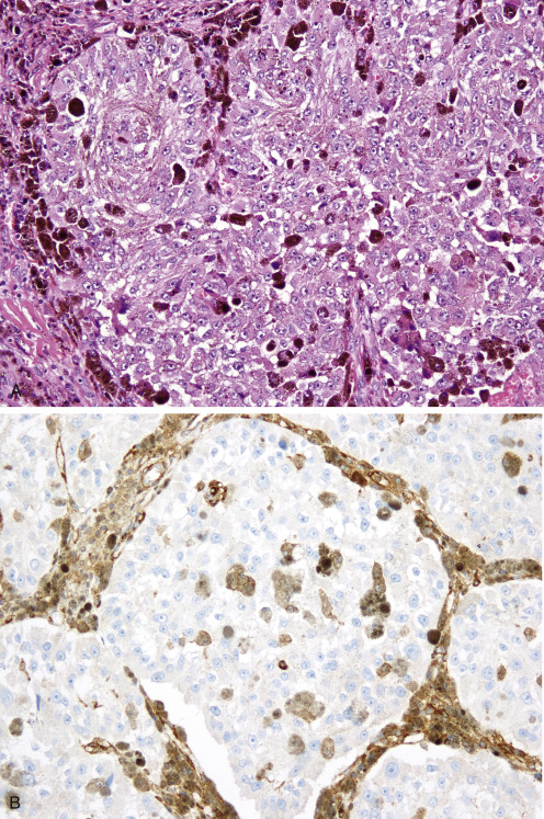 Immunohistochemistry For Analysis Of Soft Tissue Tumors | Basicmedical Key