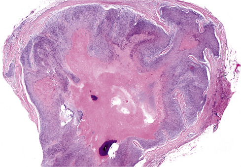 Soft Tissue Tumors Of Intermediate Malignancy Of Uncertain Type ...