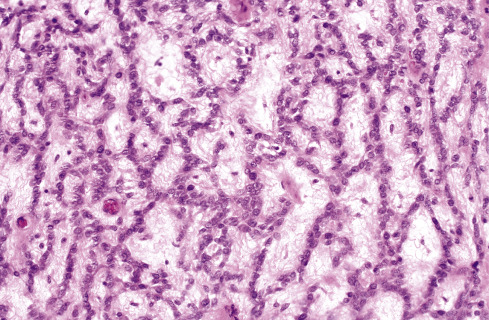 Soft Tissue Tumors Of Intermediate Malignancy Of Uncertain Type ...