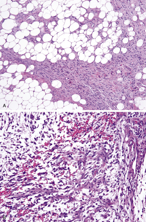 Soft Tissue Tumors Of Intermediate Malignancy Of Uncertain Type ...