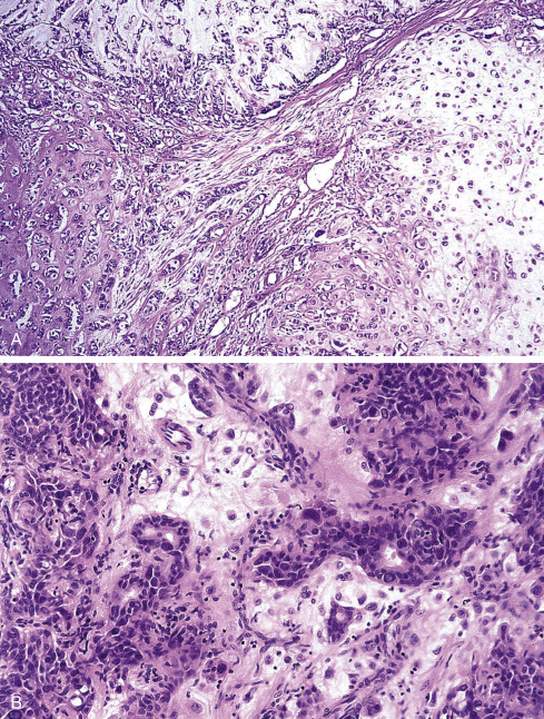 Soft Tissue Tumors Of Intermediate Malignancy Of Uncertain Type ...