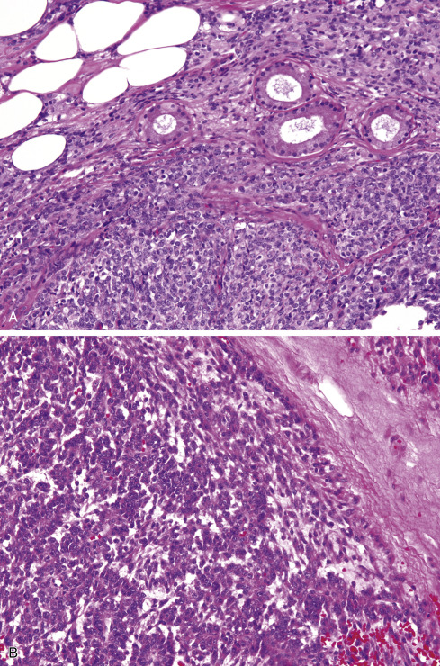 Soft Tissue Tumors Of Intermediate Malignancy Of Uncertain Type ...