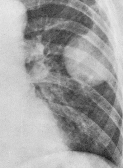 Soft Tissue Tumors Of Intermediate Malignancy Of Uncertain Type ...