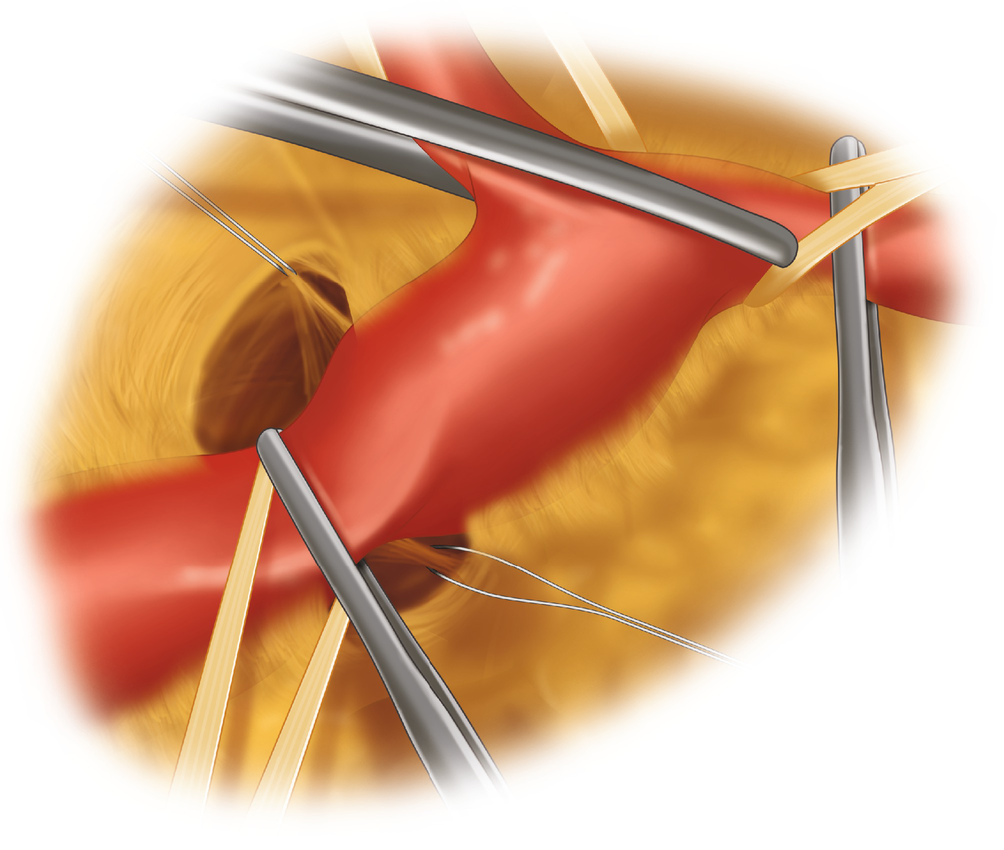 Repair Of Traumatic Thoracic Aortic Injury Without Shunt, And Using A ...