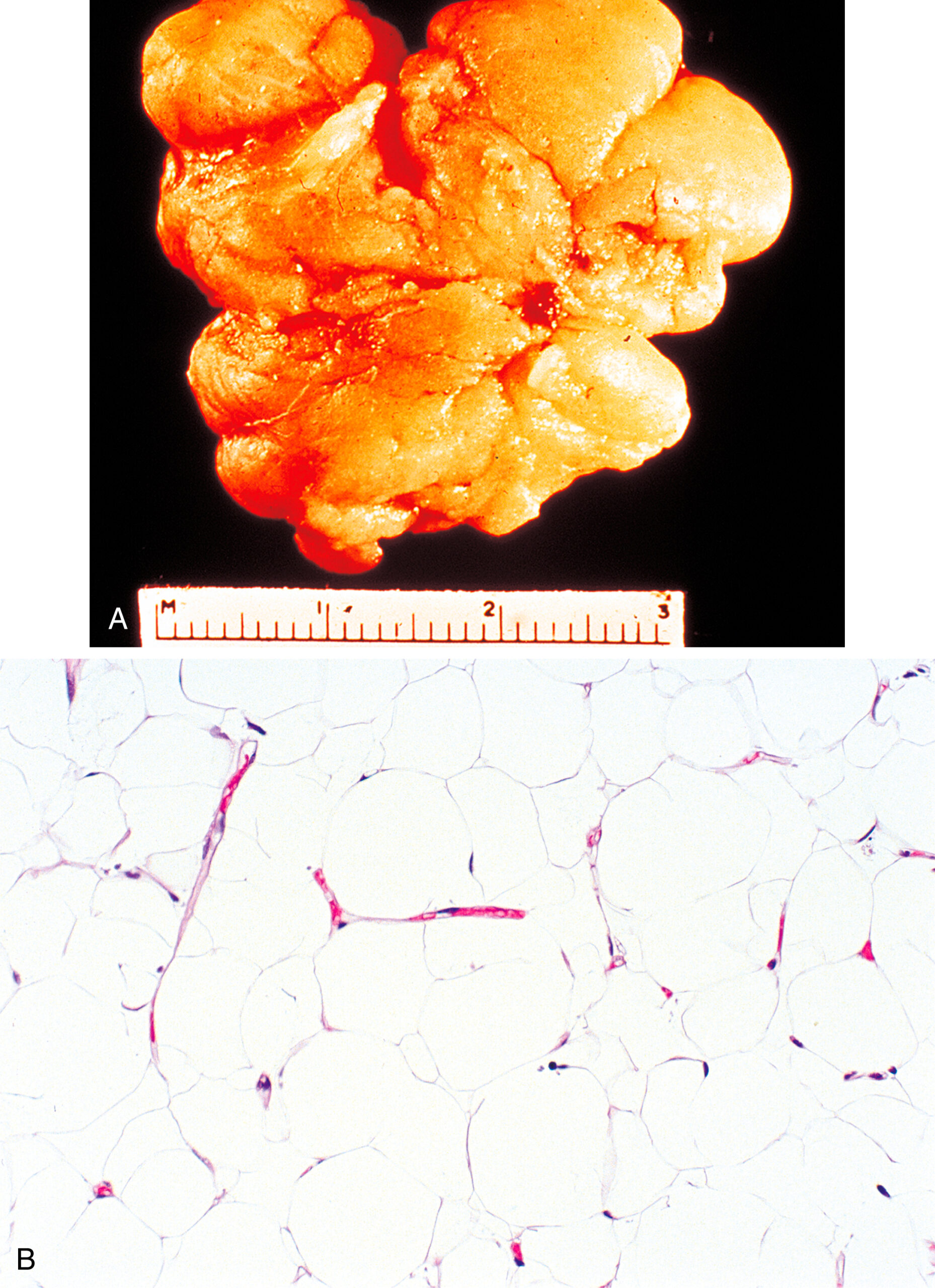 A picture contains two parts labeled A and B, displaying a lobulated excised mass and a microscopic section of round cells with clear cytoplasm separated by fibrous septa. The two parts are labeled A and B and show Lipoma. Part A displays a lobulated excised mass with a nodular surface placed above a measuring scale marked in centimeters. Part B presents a microscopic view of tissue composed of round to oval cells with clear cytoplasm and small central nuclei. The cells are separated by thin fibrous septa, and scattered capillaries are present between the cells. The structure appears uniform, and there are no additional markings or labels included in either part.