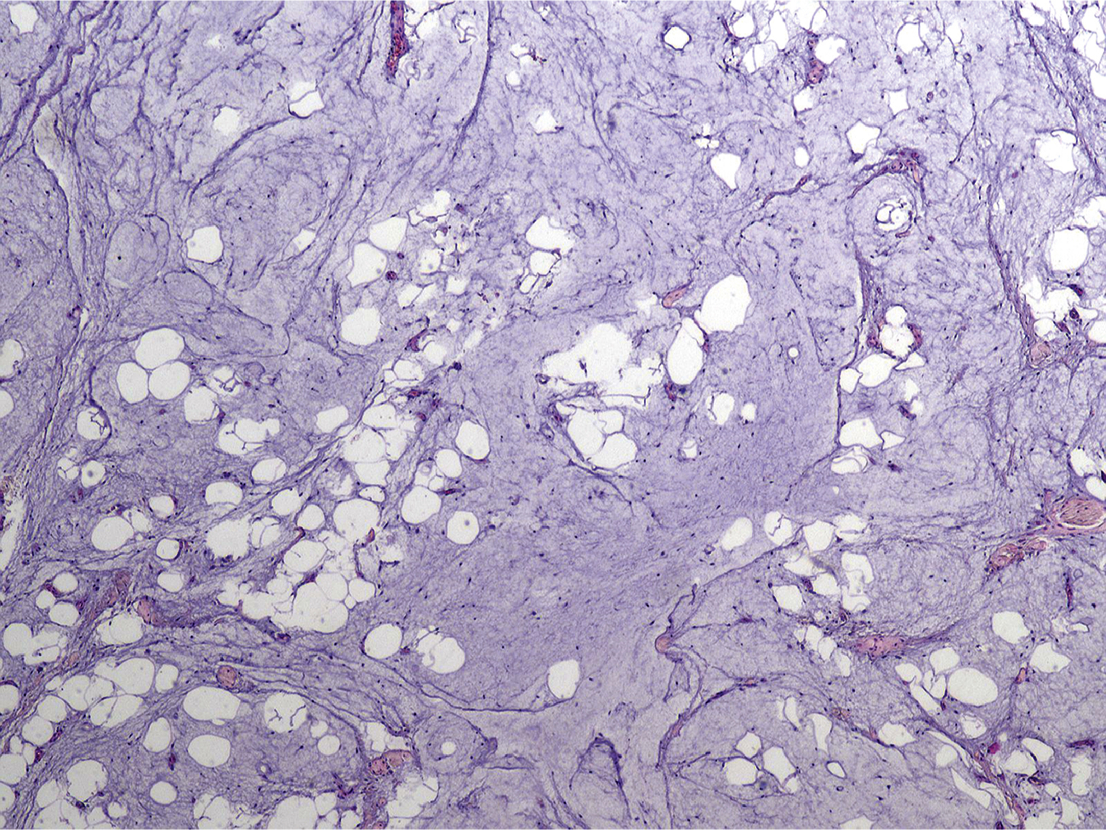 A microscopic view displays spindle-shaped cells in a myxoid matrix with scattered round vacuolated cells dispersed throughout the section.