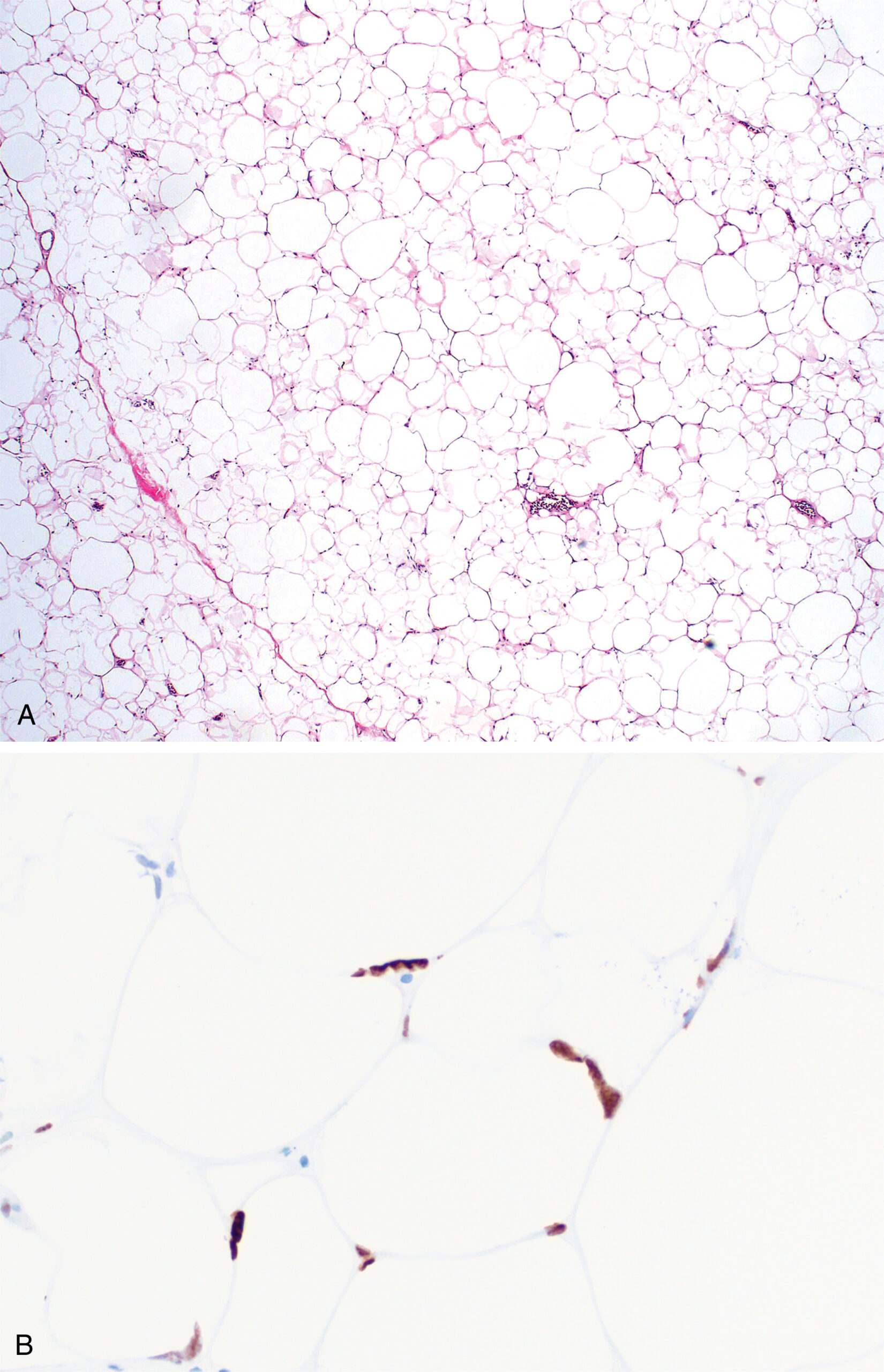 A set of two micrographs labeled A and B depicts adipose tissue with different staining techniques highlighting cellular and structural features of Anisometric cell lipoma. The two micrographs, labeled A and B, display histological sections of adipose tissue showing Anisometric cell lipoma. Part A, stained with hematoxylin and eosin, reveals numerous adipocytes characterized by clear cytoplasmic spaces and peripherally located nuclei. Part B, using immunohistochemical staining, highlights positively stained spindle-shaped and elongated cells interspersed among the adipocytes, suggesting the presence of stromal or immune cells within the adipose tissue matrix.