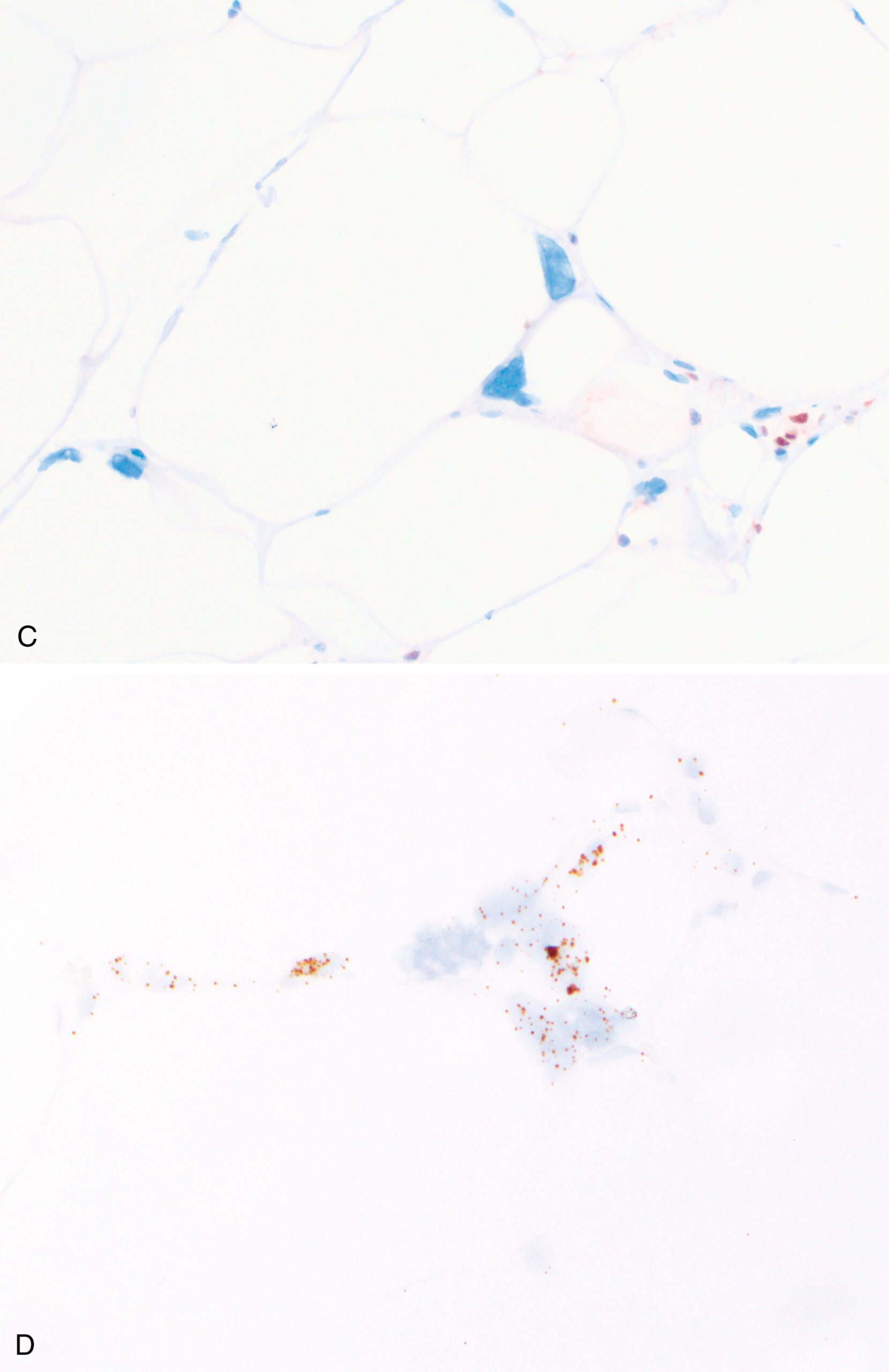 A set of two micrographs labeled A and B depicts adipose tissue with different staining techniques highlighting cellular and structural features of Anisometric cell lipoma. The two micrographs, labeled A and B, display histological sections of adipose tissue showing Anisometric cell lipoma. Part A, stained with hematoxylin and eosin, reveals numerous adipocytes characterized by clear cytoplasmic spaces and peripherally located nuclei. Part B, using immunohistochemical staining, highlights positively stained spindle-shaped and elongated cells interspersed among the adipocytes, suggesting the presence of stromal or immune cells within the adipose tissue matrix.
