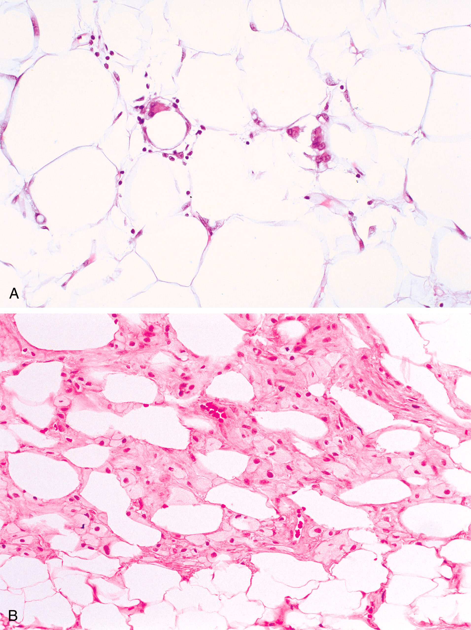 A picture of two histological sections of bone marrow labeled A and B, each displaying variations in cellular density and adipocyte presence. The two histological sections of bone marrow, labeled A and B, show variations in cellular density and adipocyte presence. Part A displays large adipocytes with minimal hematopoietic cells and sparse stromal elements, indicating low cellular activity. In contrast, Part B contains fewer adipocytes and increased hematopoietic cells, which are more evenly distributed throughout the section. The interstitial spaces in Part B appear more compact, reflecting a higher degree of marrow cellularity and hematopoietic activity compared to Part A.