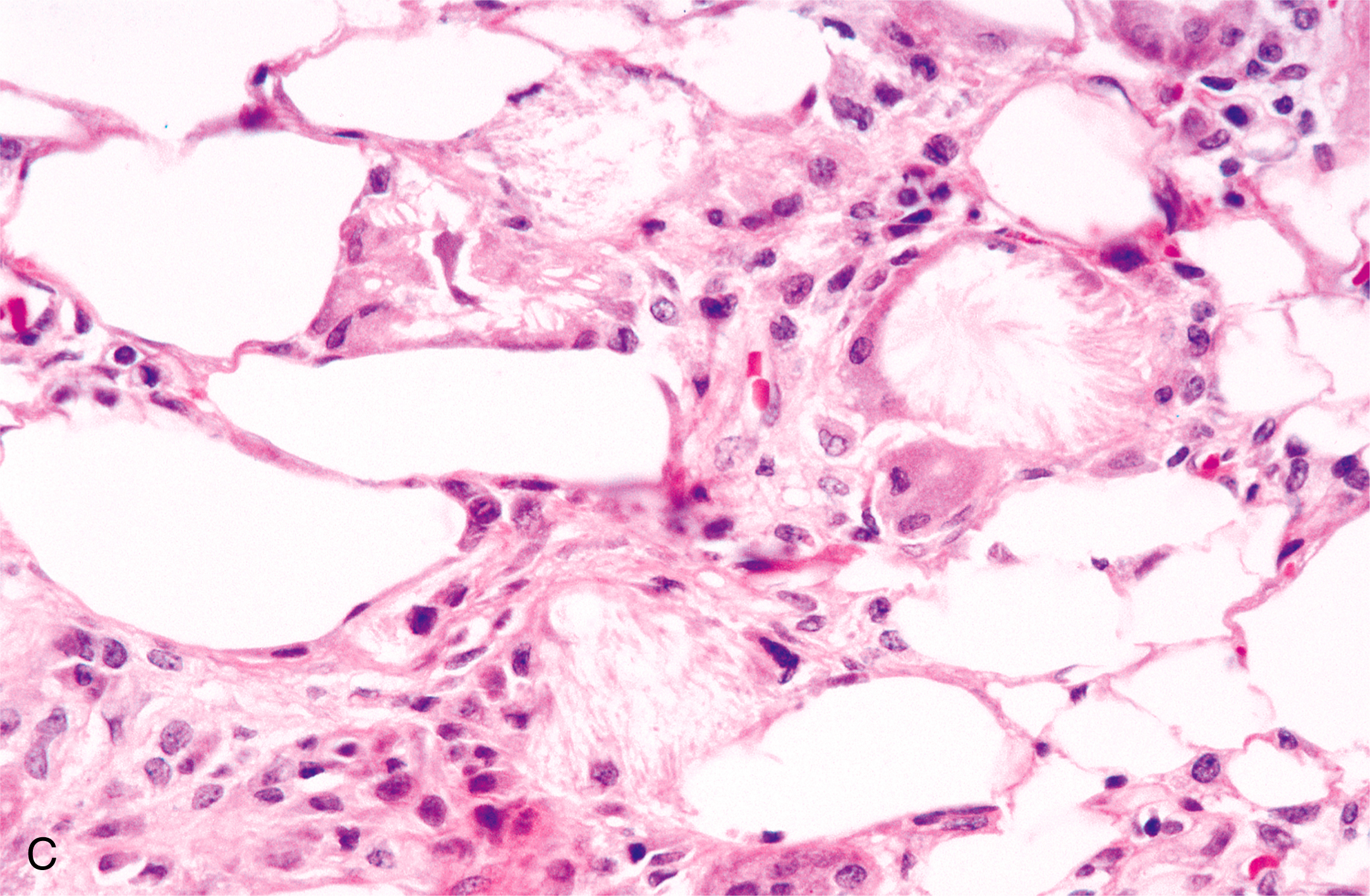 A picture of two histological sections of bone marrow labeled A and B, each displaying variations in cellular density and adipocyte presence. The two histological sections of bone marrow, labeled A and B, show variations in cellular density and adipocyte presence. Part A displays large adipocytes with minimal hematopoietic cells and sparse stromal elements, indicating low cellular activity. In contrast, Part B contains fewer adipocytes and increased hematopoietic cells, which are more evenly distributed throughout the section. The interstitial spaces in Part B appear more compact, reflecting a higher degree of marrow cellularity and hematopoietic activity compared to Part A.