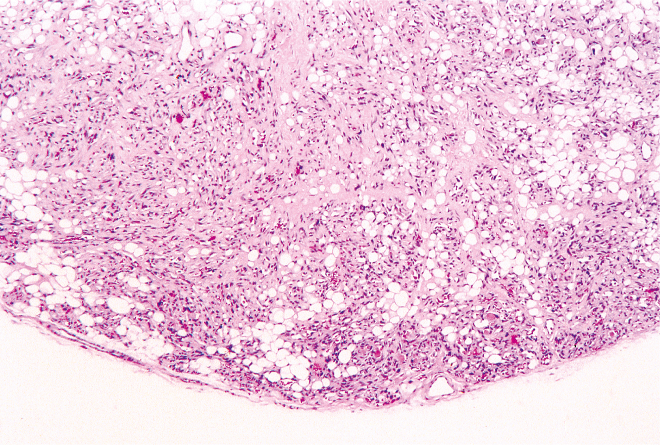 A microscopic view of the bone marrow shows many cells and small fat cells spread throughout with clear tissue separation and increased growth of blood vessels between mature fat cells.