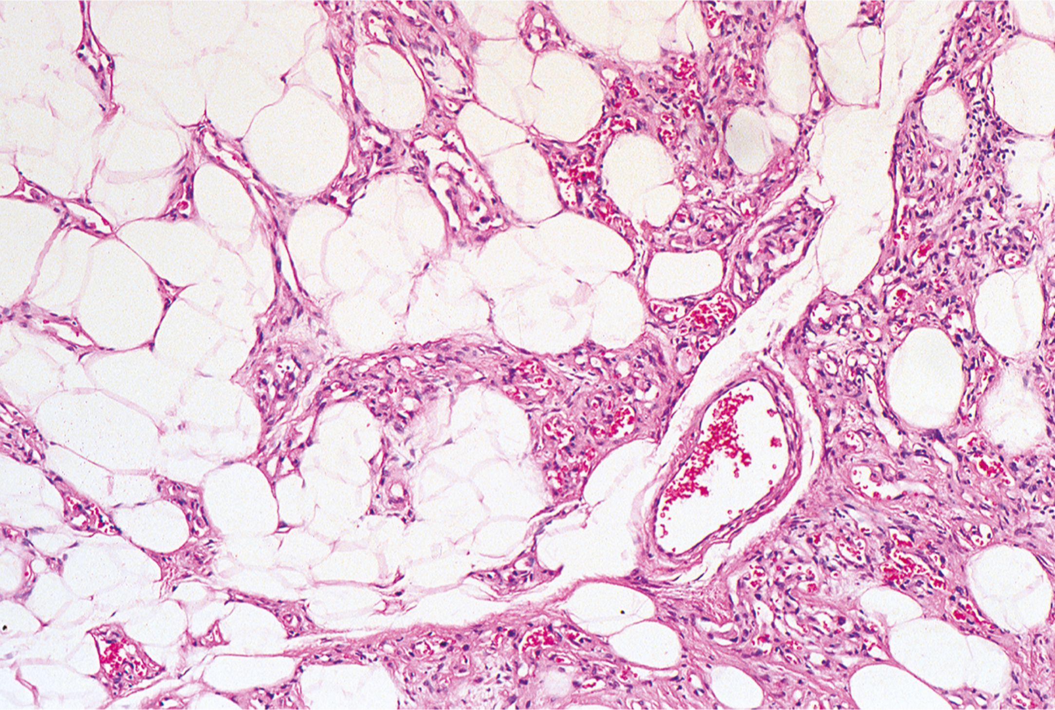 A microscopic view of bone marrow with abundant adipocytes, sparse hematopoietic cells, and a prominent vascular structure containing red blood cells.