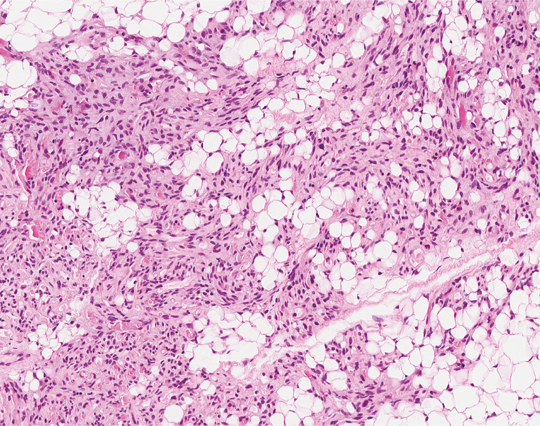 A microscopic view of bone marrow with moderate hematopoietic cellularity, numerous small adipocytes, and scattered stromal elements.