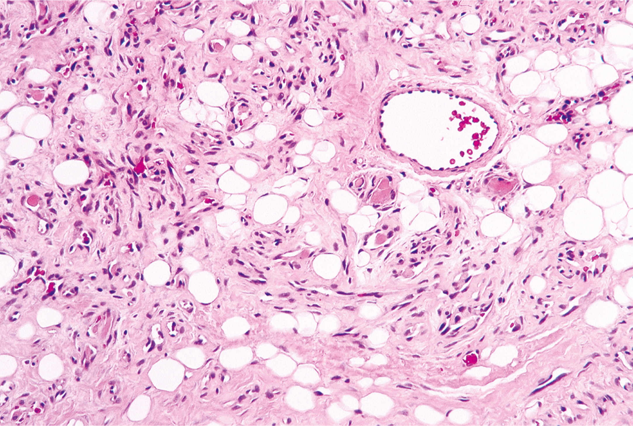 A microscopic view of bone marrow with low hematopoietic cellularity, small adipocytes, fibrous stroma, and a central vessel containing red blood cells.