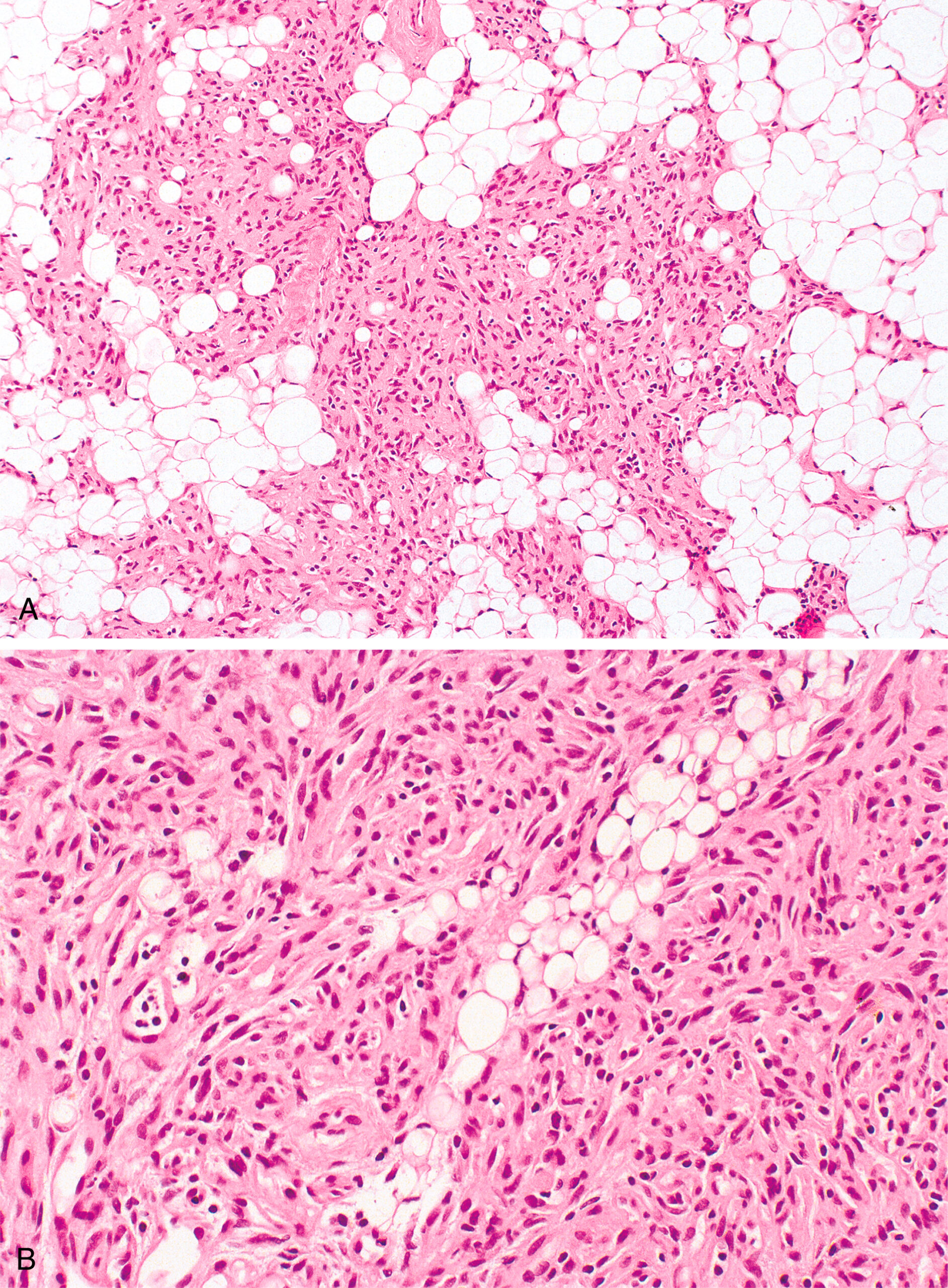 A set of two microscopic views of bone marrow labeled A and B with varying adipocyte content, cellular density, and immunohistochemical staining patterns of angiolipoma. The set of two microscopic views of bone marrow labeled A and B shows angiolipoma. Part A displays a high density of hematopoietic cells with interspersed large adipocytes occupying less than half of the section. The adipocytes are round and variably sized, surrounded by numerous closely packed hematopoietic elements. Part B shows reduced cellularity with more fibrous stromal elements and smaller adipocytes scattered throughout the section. The hematopoietic cells appear sparse and are more isolated within the stromal tissue. A vessel is visible with a surrounding fibrous structure.