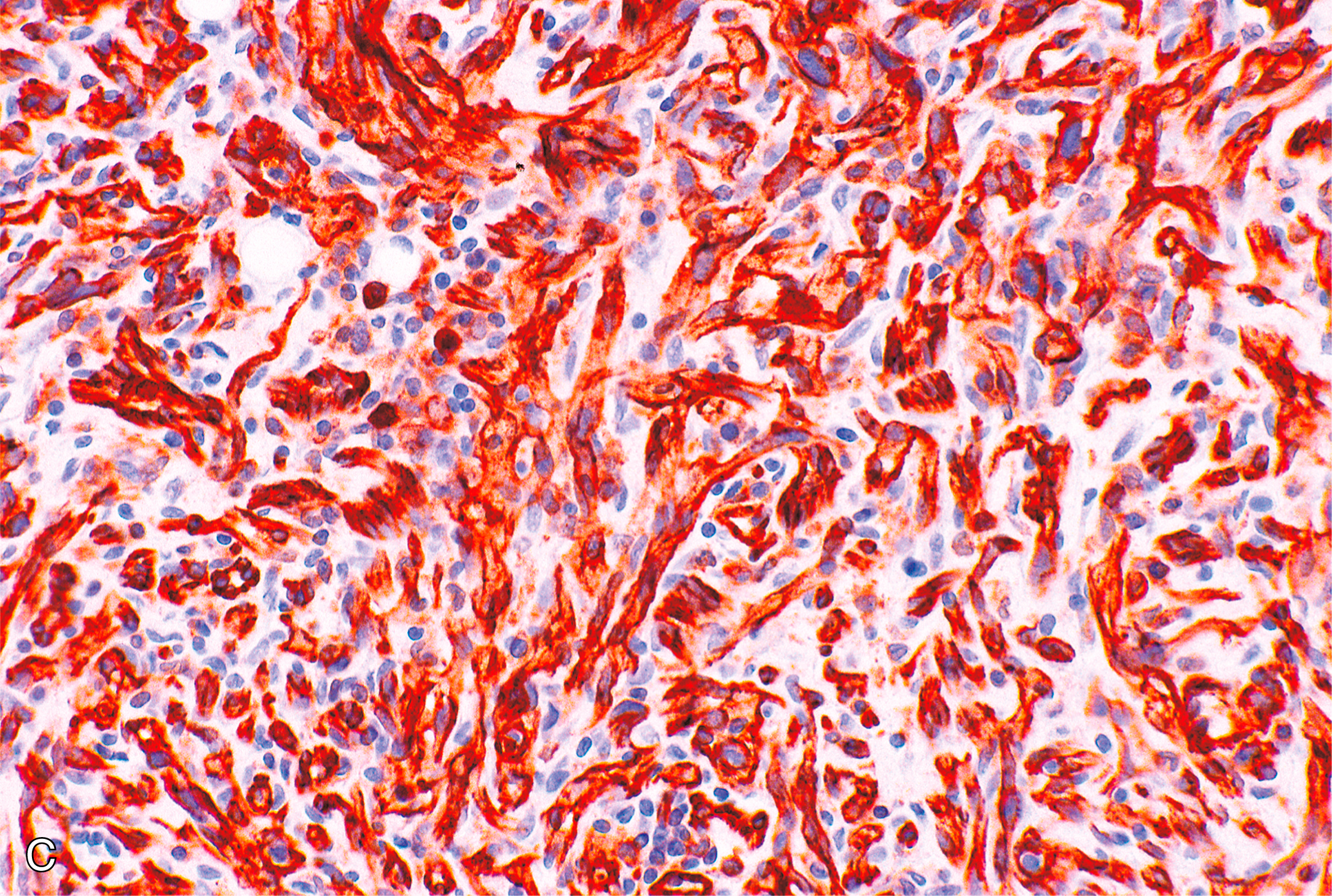 A set of two microscopic views of bone marrow labeled A and B with varying adipocyte content, cellular density, and immunohistochemical staining patterns of angiolipoma. The set of two microscopic views of bone marrow labeled A and B shows angiolipoma. Part A displays a high density of hematopoietic cells with interspersed large adipocytes occupying less than half of the section. The adipocytes are round and variably sized, surrounded by numerous closely packed hematopoietic elements. Part B shows reduced cellularity with more fibrous stromal elements and smaller adipocytes scattered throughout the section. The hematopoietic cells appear sparse and are more isolated within the stromal tissue. A vessel is visible with a surrounding fibrous structure.